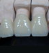 Ceramage polymeric nano-porcelain tooth