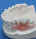 Concealed denture/ flexible denture